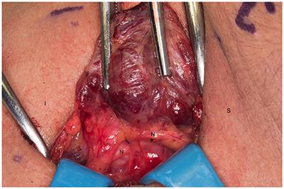 Intraoperative Decision-Making and Technical Aspects of Parathyroidectomy in Young Patients With MEN1 Related Hyperparathyroidism